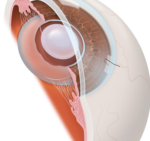 our eye has a natural lens, a clear, flexible disc of tissue behind the pupil that helps the eye focus the light that comes into it onto the retina — a critical part of vision.